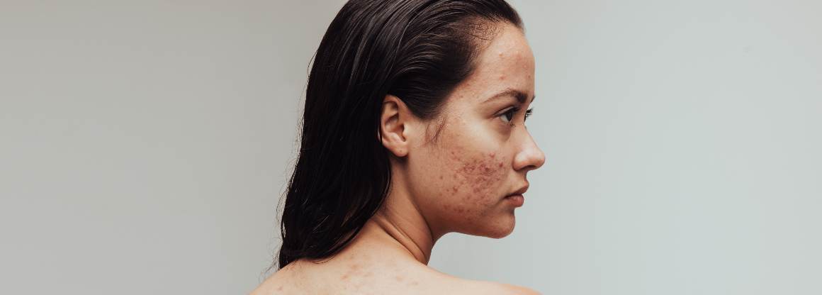 Welke voedingsmiddelen veroorzaken acne? De 9 belangrijkste voedingsmiddelen die acne veroorzaken